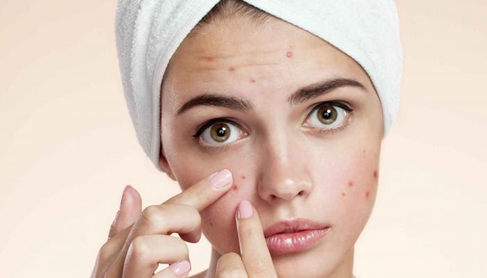 47-102147-reasons-acne-cure-prevent_700x400